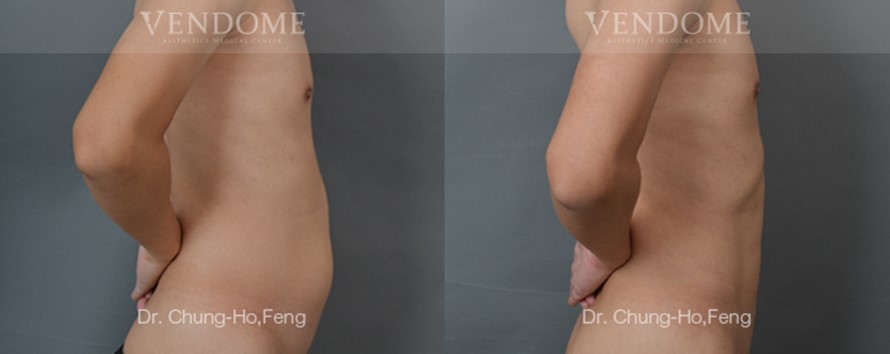 男性腰腹部抽脂人魚線雕塑術前術後側面對比