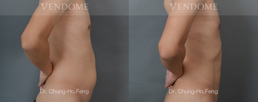 男性腰腹部抽脂人魚線雕塑術前術後側面對比