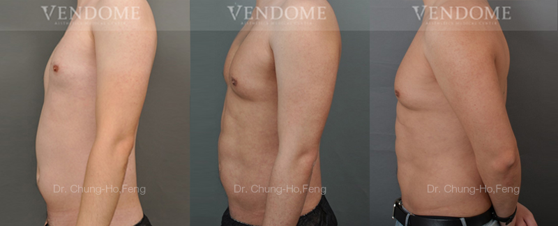 男性腰腹部抽脂胸肌雕塑追蹤側面