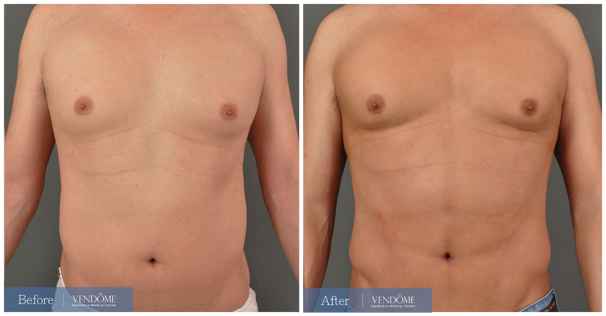 男性腰腹部抽脂案例手術後八個月