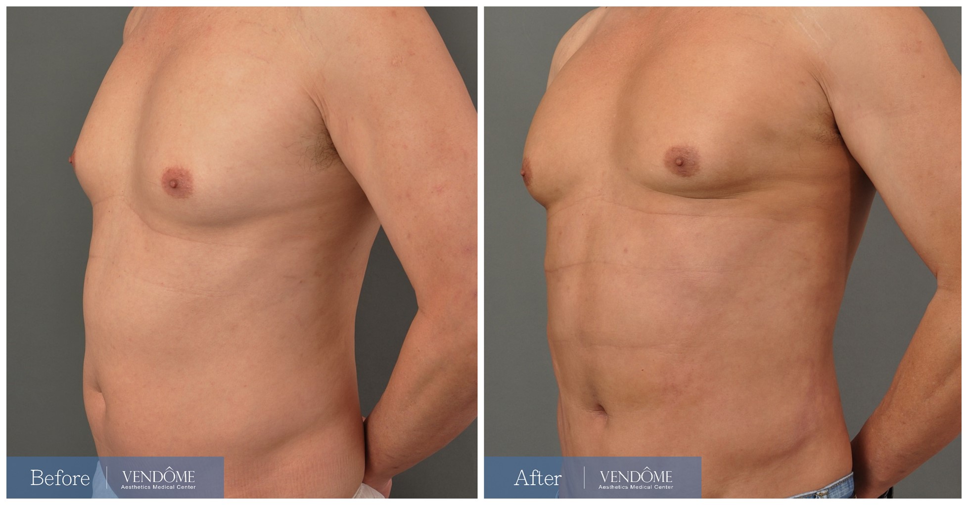 男性腰腹部抽脂胸腹肌雕塑術前術後側面對比
