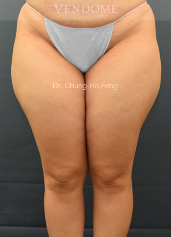 女性大腿抽脂手術前正面