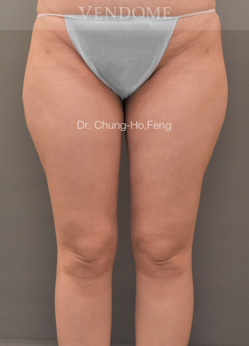 女性大腿抽脂手術後正面