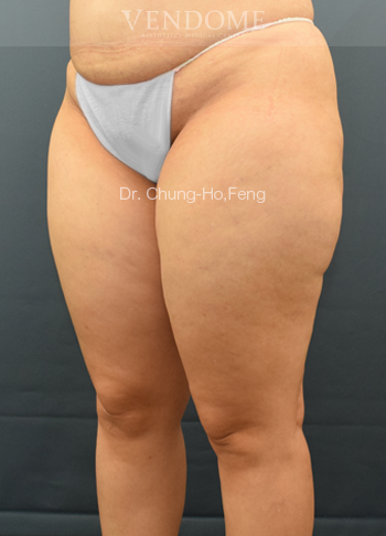 女性大腿抽脂手術前
