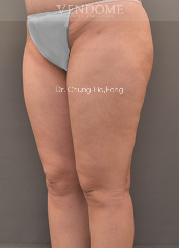 女性大腿抽脂手術後