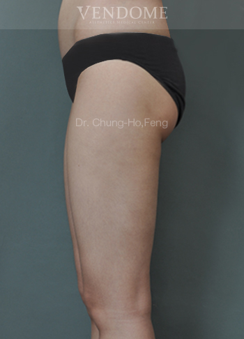 女性大腿抽脂手術後