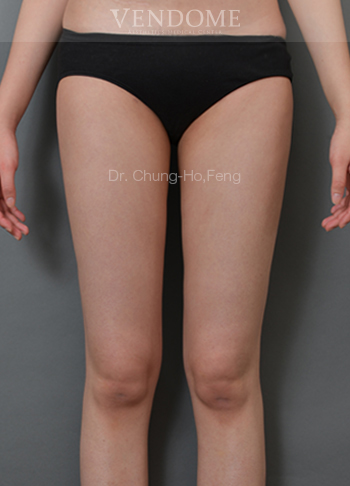 大腿抽脂手術後