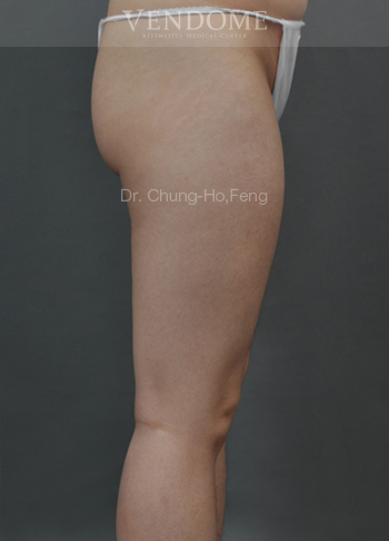 大腿抽脂手術前
