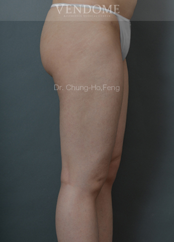 大腿抽脂手術後