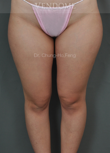 女-大腿抽脂手術前正面照