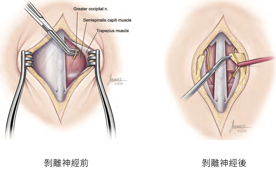 偏頭痛,偏頭痛治療,偏頭痛針劑治療,偏頭痛手術治療