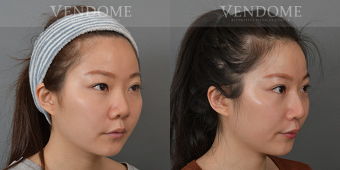 隆鼻手術案例成效 45度臉部照