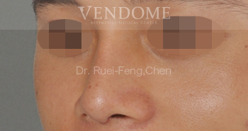 韓式隆鼻,蒜頭鼻,隆鼻,隆鼻手術,台北隆鼻手術,新竹隆鼻手術,台南隆鼻手術