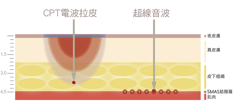 電波拉皮,音波拉皮