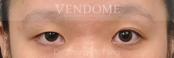 縫雙眼皮,割雙眼皮,台北雙眼皮手術,新竹雙眼皮手術,台南雙眼皮手術