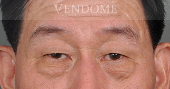 除眼袋/ 開眼袋 眼袋手術術前案例