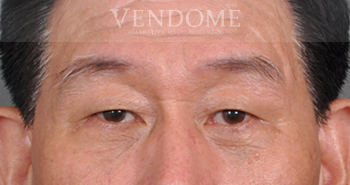 眼袋類型 眼袋手術術後案例