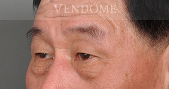 眼袋成因 眼袋手術術前案例