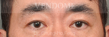 縫雙眼皮,割雙眼皮,台北雙眼皮手術,新竹雙眼皮手術,台南雙眼皮手術