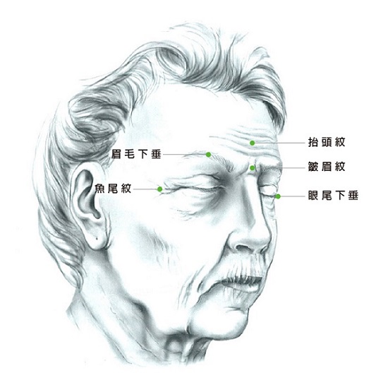 適合做內視鏡前額拉皮手術的症狀示意圖