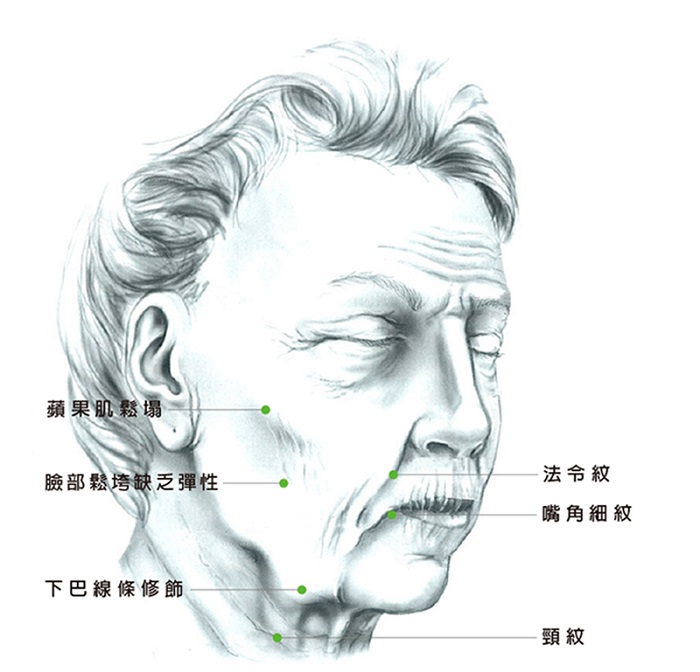 適合做中下臉拉皮、頸部拉皮手術的症狀示意圖