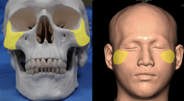 顴骨削骨位置