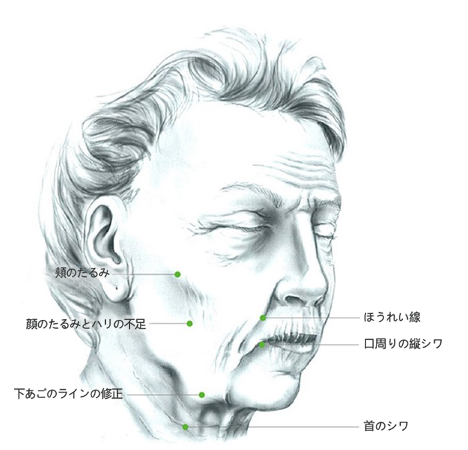 內視鏡拉皮,前額拉皮