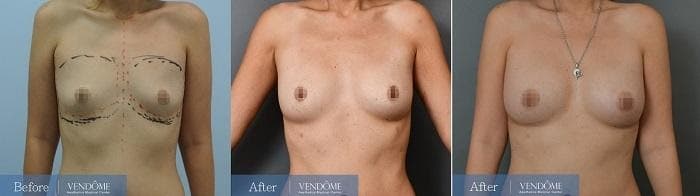 自體脂肪隆乳術前術後