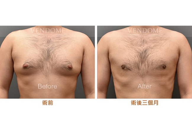 男性抽脂精隨(II) - 男性女乳 重建完美的胸大肌型態！