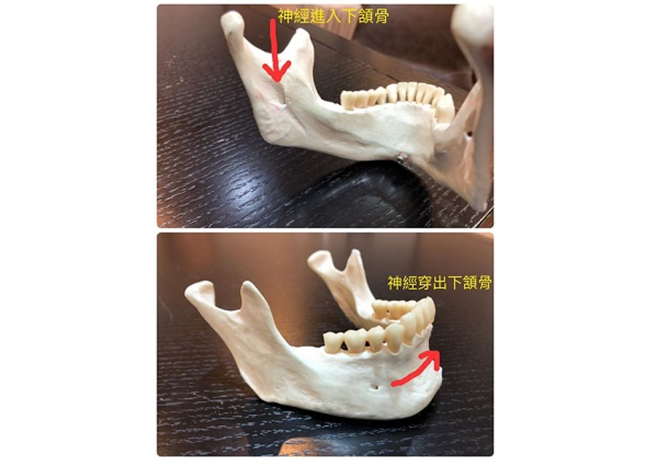 為什麼正顎手術或下顎骨角削骨手術後，下唇和下巴會麻麻的？