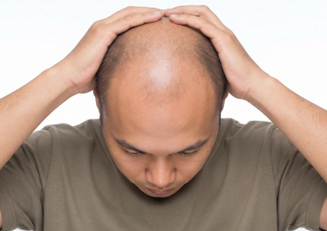 雄性禿會好嗎？雄性禿成因、階段、治療⽅式與植髮全解