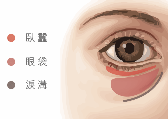 眼袋手術是什麼？3 個常見眼袋手術 恢復年輕有神的雙眼！