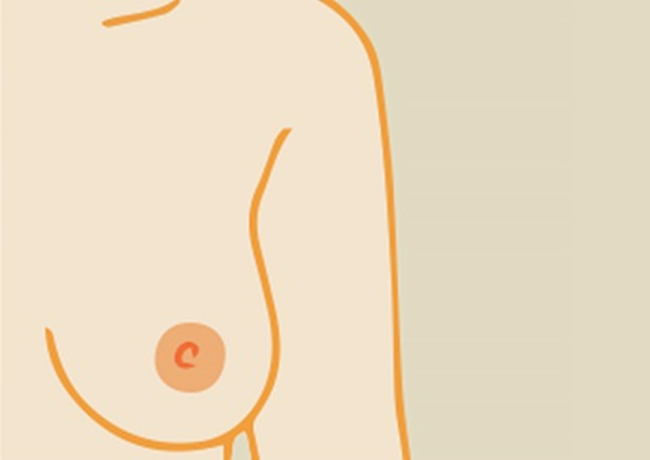 隆乳手術方式比較