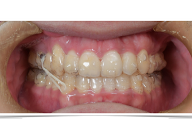 Clear Aligner 與 正顎手術
