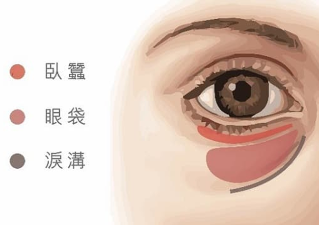 臥蠶、眼袋、淚溝、黑眼圈 先了解這些的差別吧！