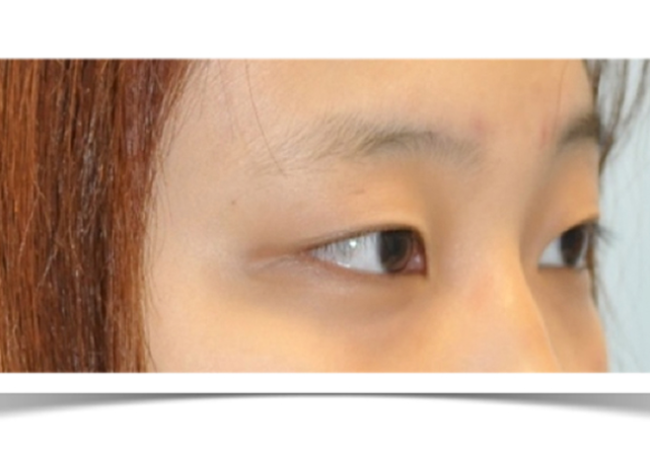 雙眼皮(double eyelid fold)：縫的? 割的？