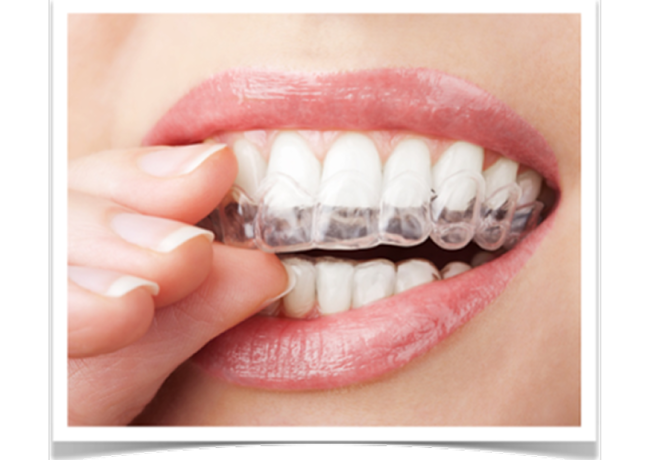 隱形牙套 Invisalign 與 正顎