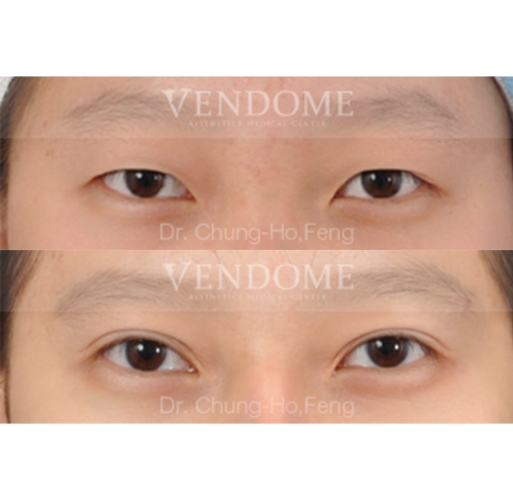 割雙眼皮