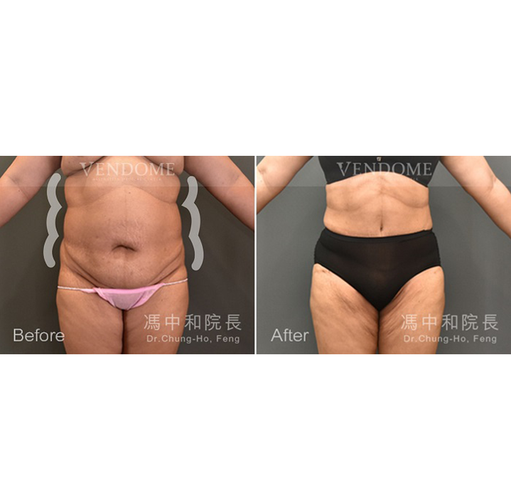 腹部拉皮案例分享