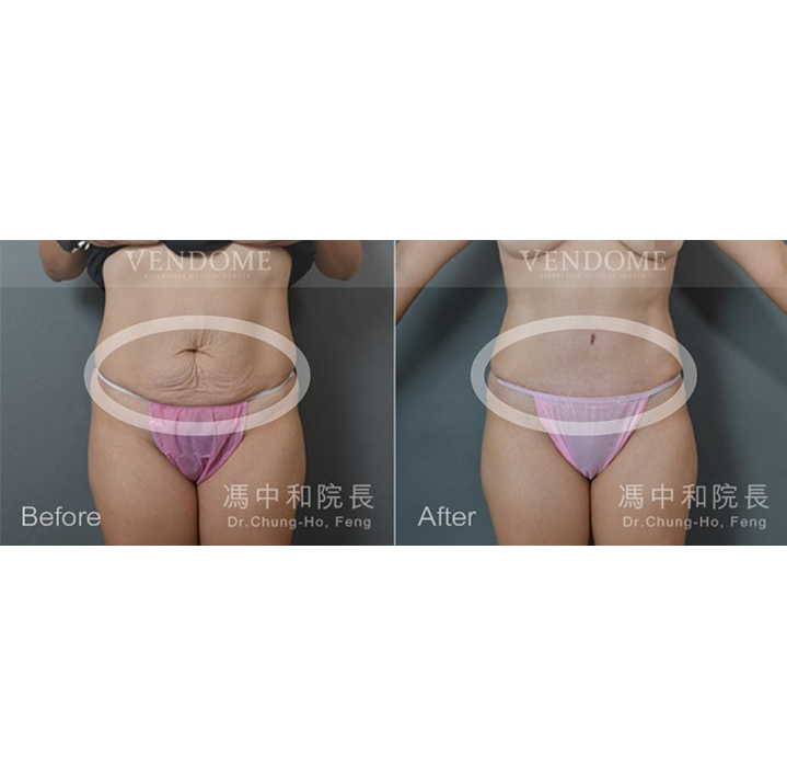 腹部拉皮案例分享