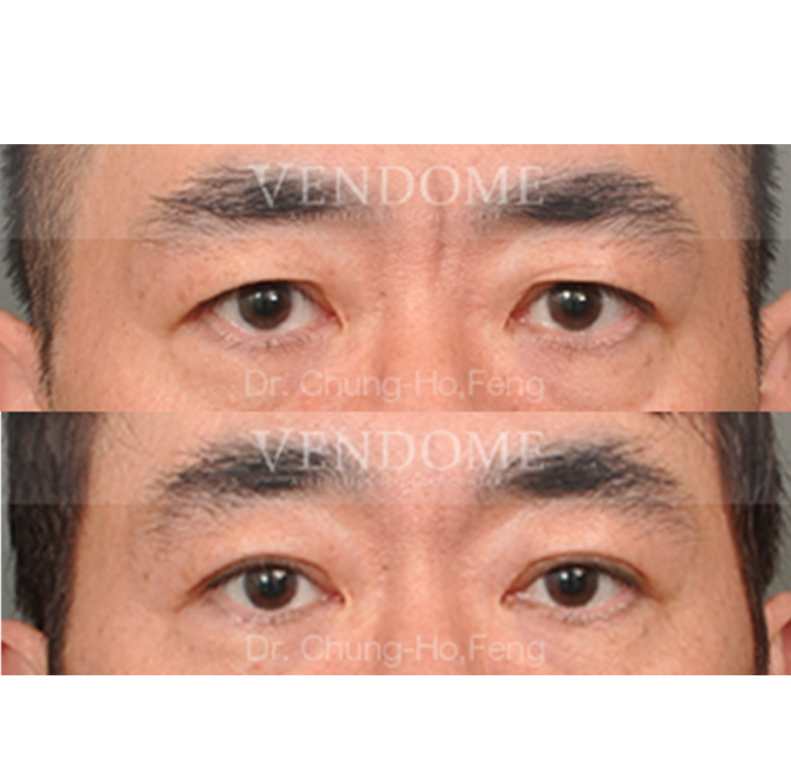 割雙眼皮+前額五爪拉皮