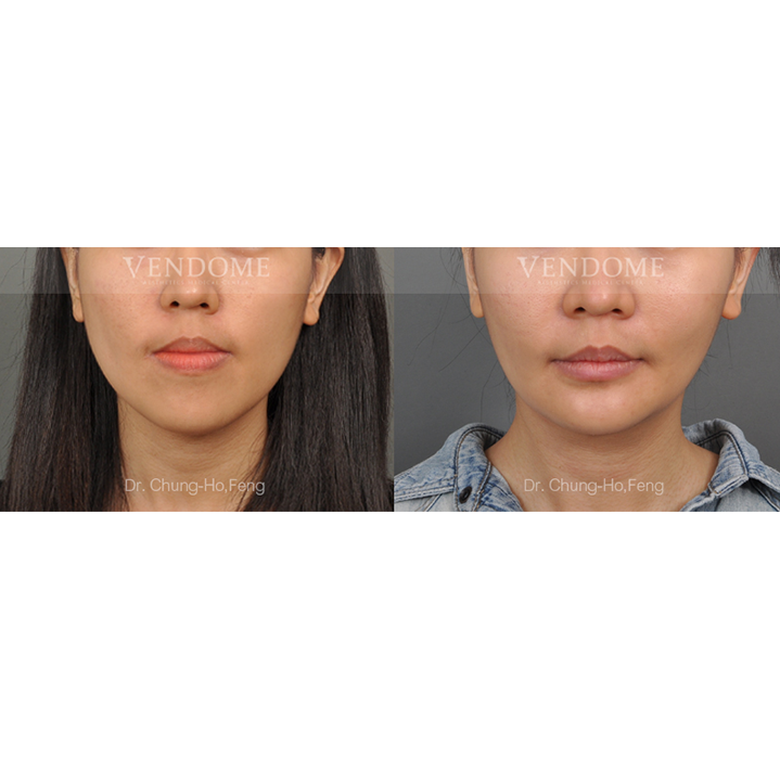 正顎削骨後 年輕化拉皮手術