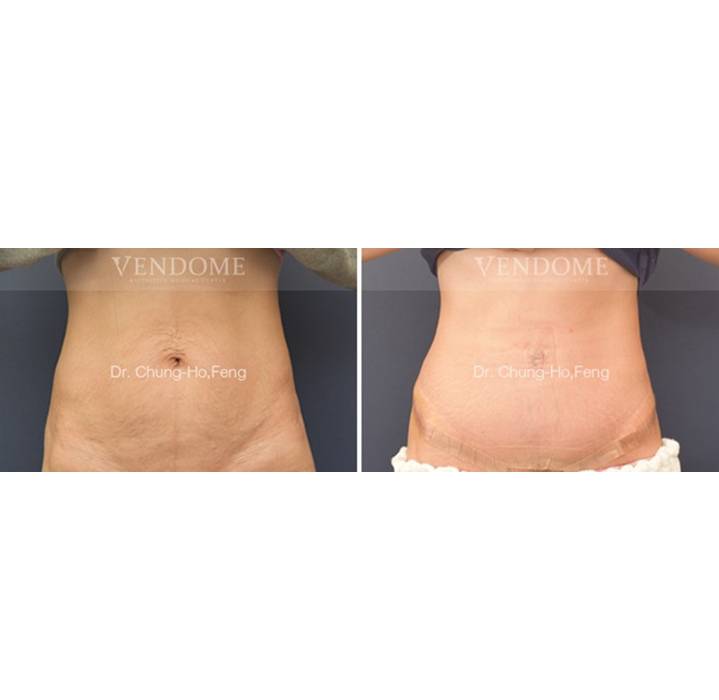 腹部拉皮案例分享