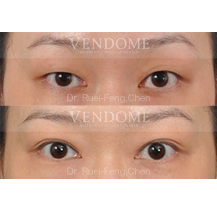 縫雙眼皮