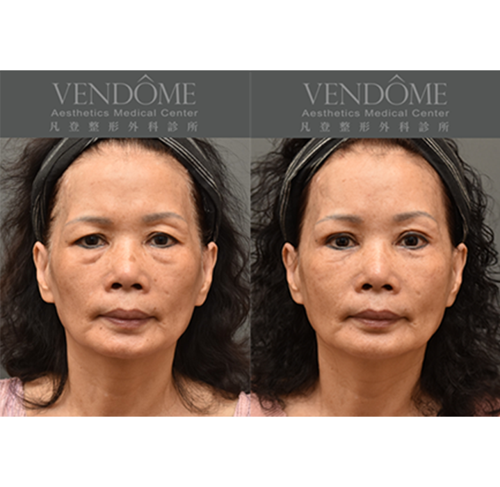 功能性前額拉皮可改善眉眼下垂