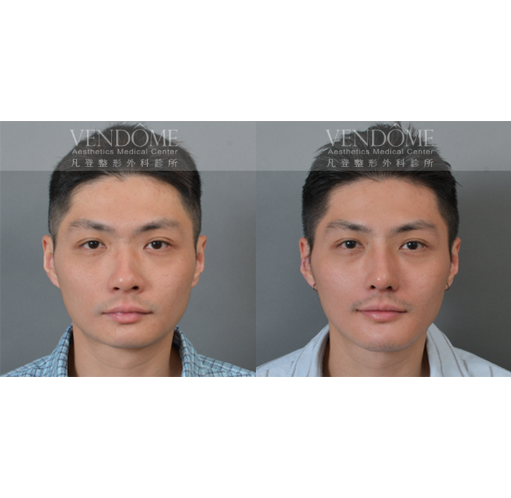 隆鼻手術
