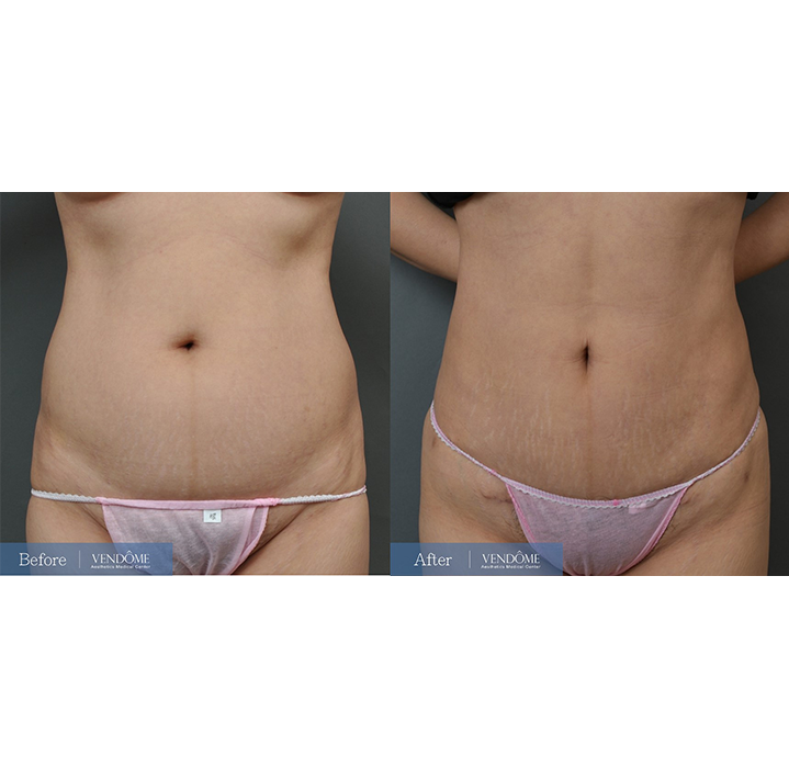 腹部拉皮案例分享