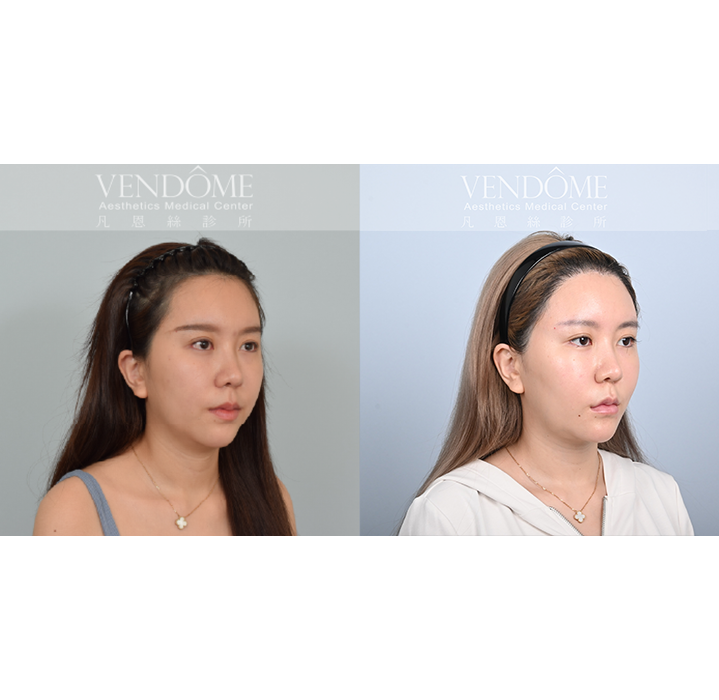 女性美型髮際線