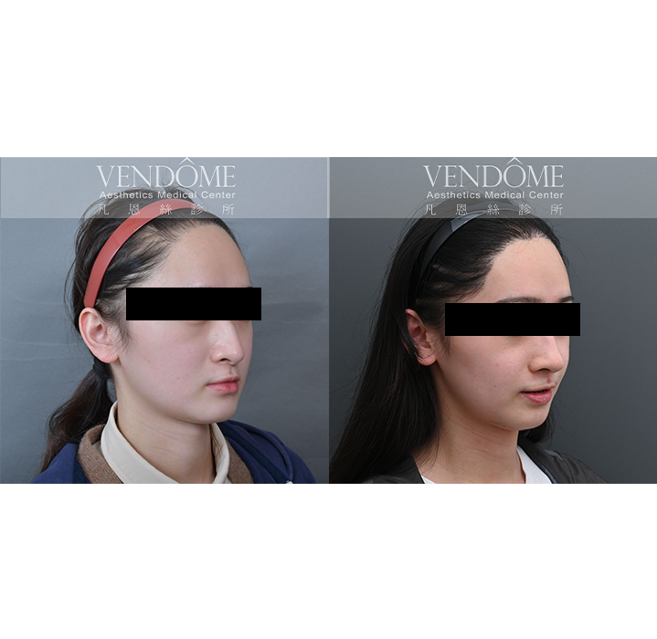 女性美型髮際線