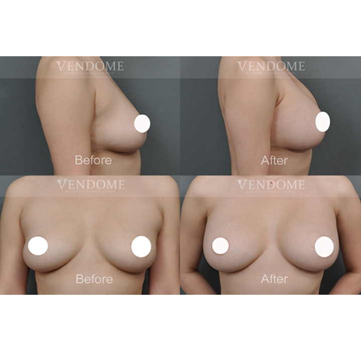 曼陀女王波 A cup